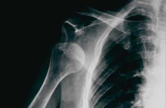 肩関節脱臼｜宗像市 はりきゅう整骨院 K MEDICAL