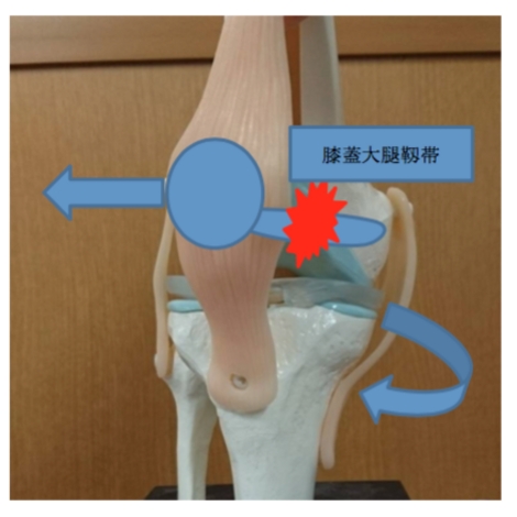 膝蓋骨脱臼