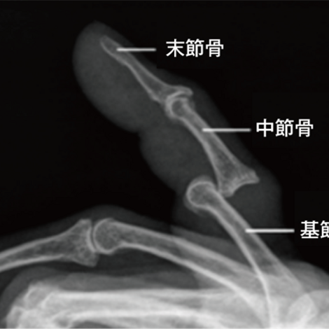 指関節脱臼